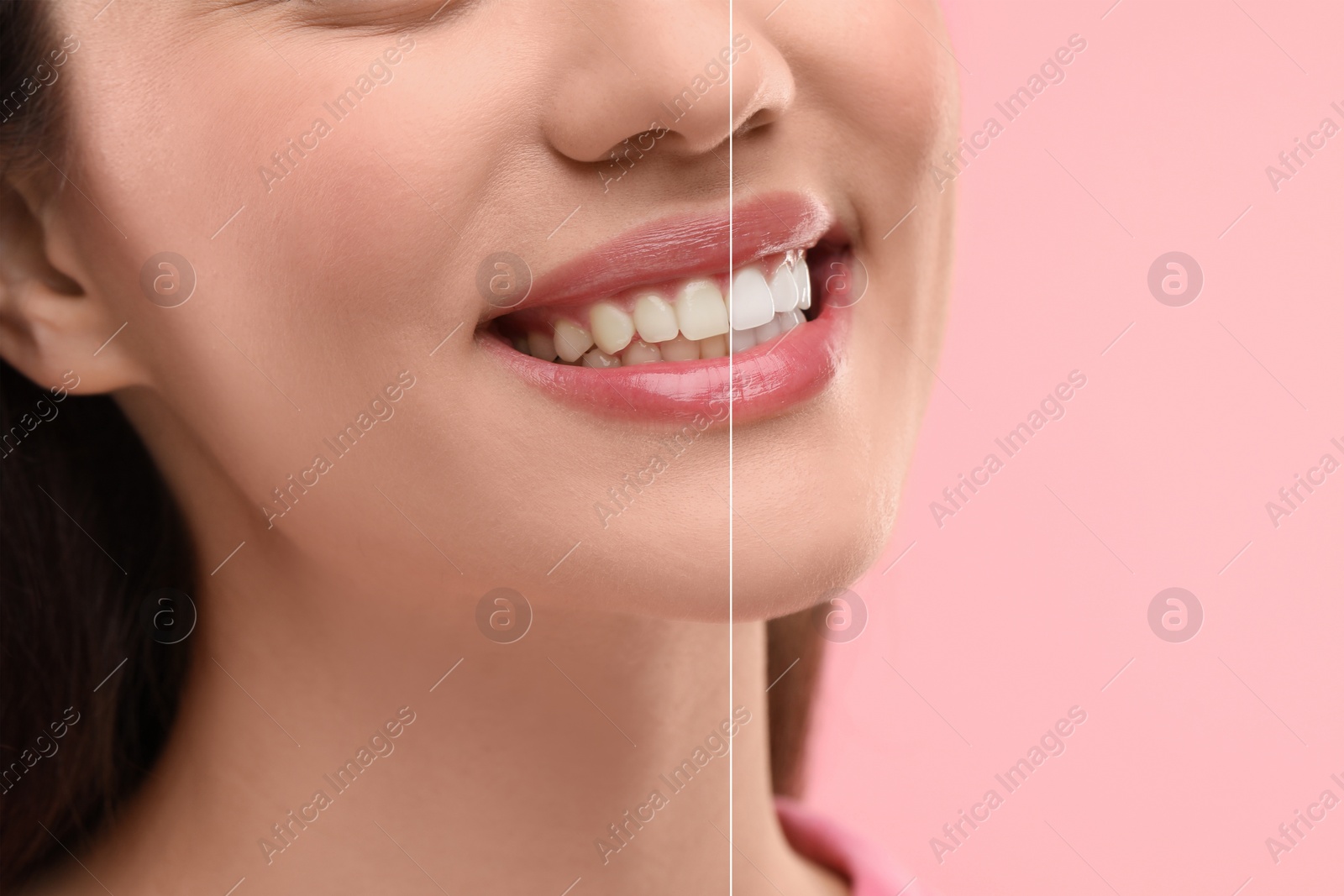 Image of Woman showing teeth before and after whitening on pink background, collage