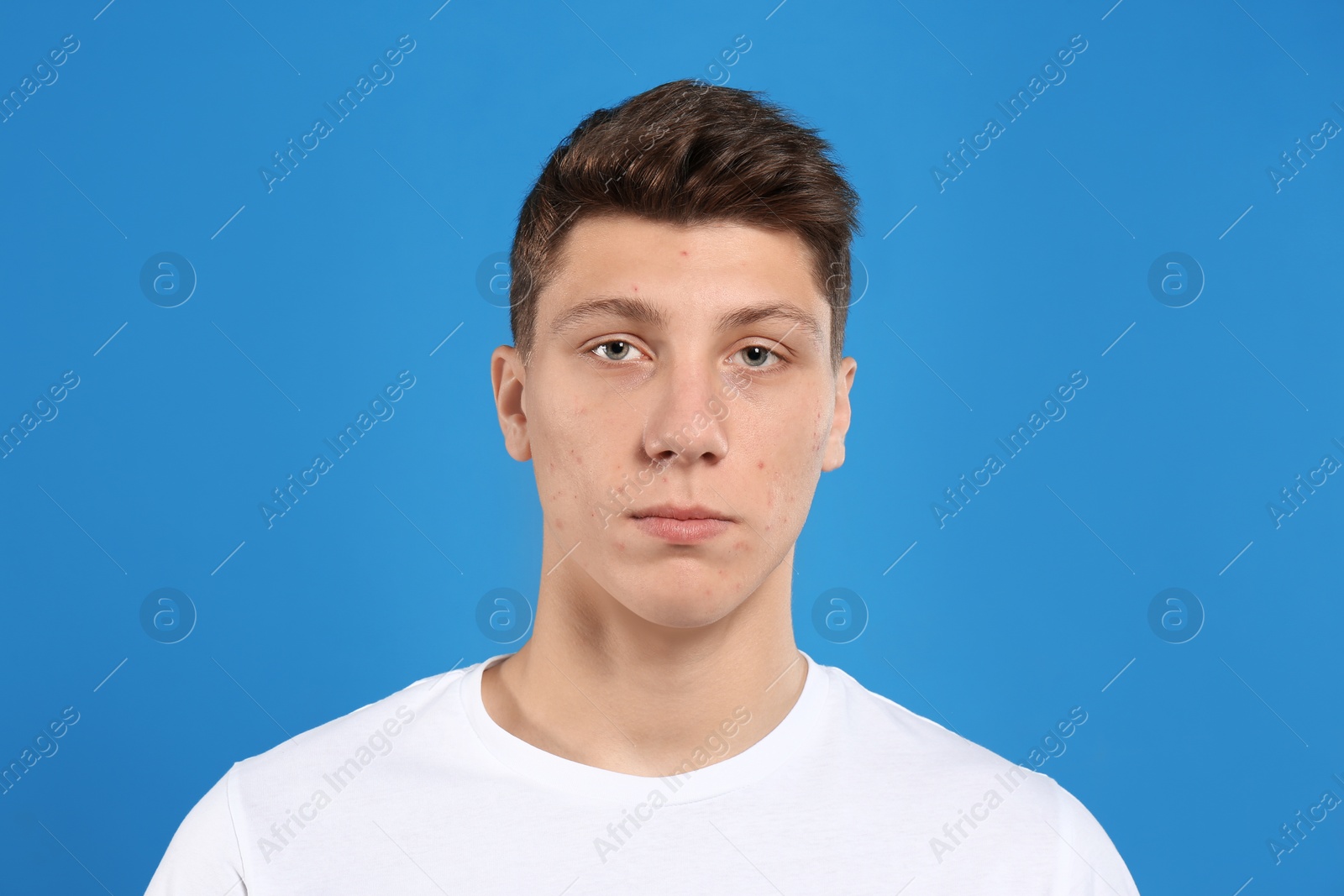 Photo of Teen guy with acne problem on blue background