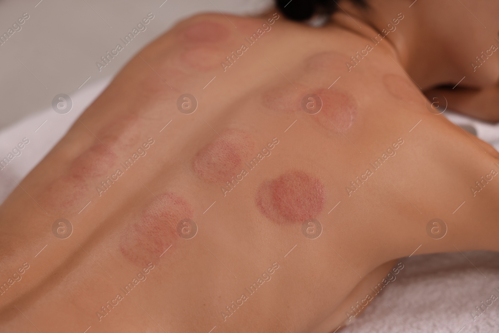 Photo of Closeup view of woman after cupping therapy indoors