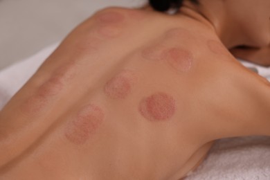 Closeup view of woman after cupping therapy indoors