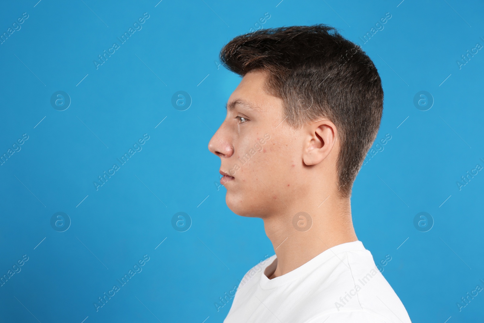 Photo of Teen guy with acne problem on blue background. Space for text