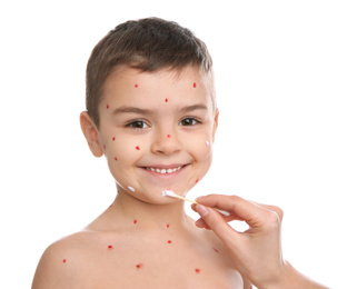 Woman applying cream onto skin of little boy with chickenpox on white background
