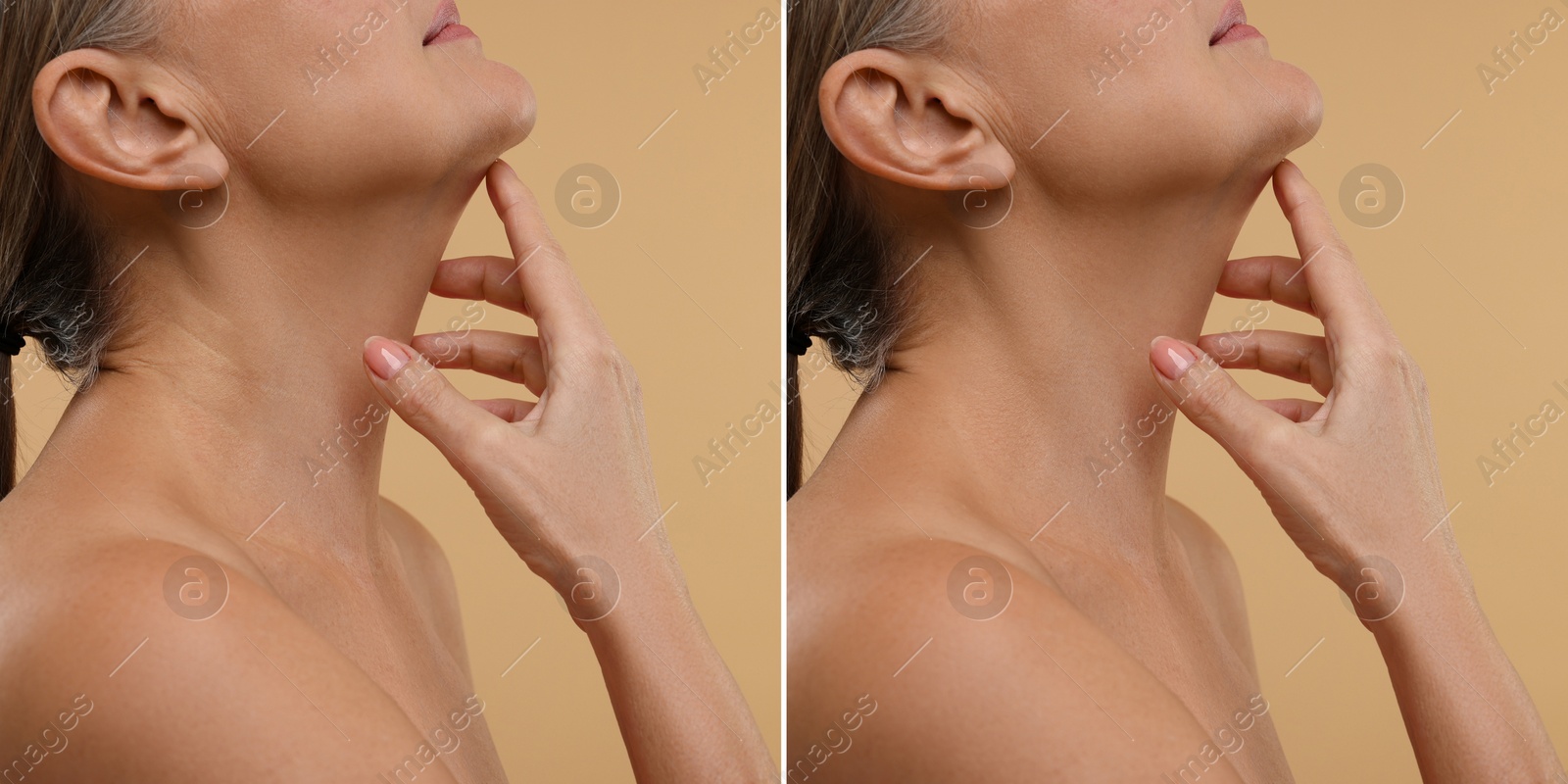 Image of Collage with photos of woman before and after cosmetic procedure on beige background, closeup