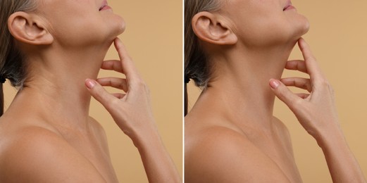 Image of Collage with photos of woman before and after cosmetic procedure on beige background, closeup