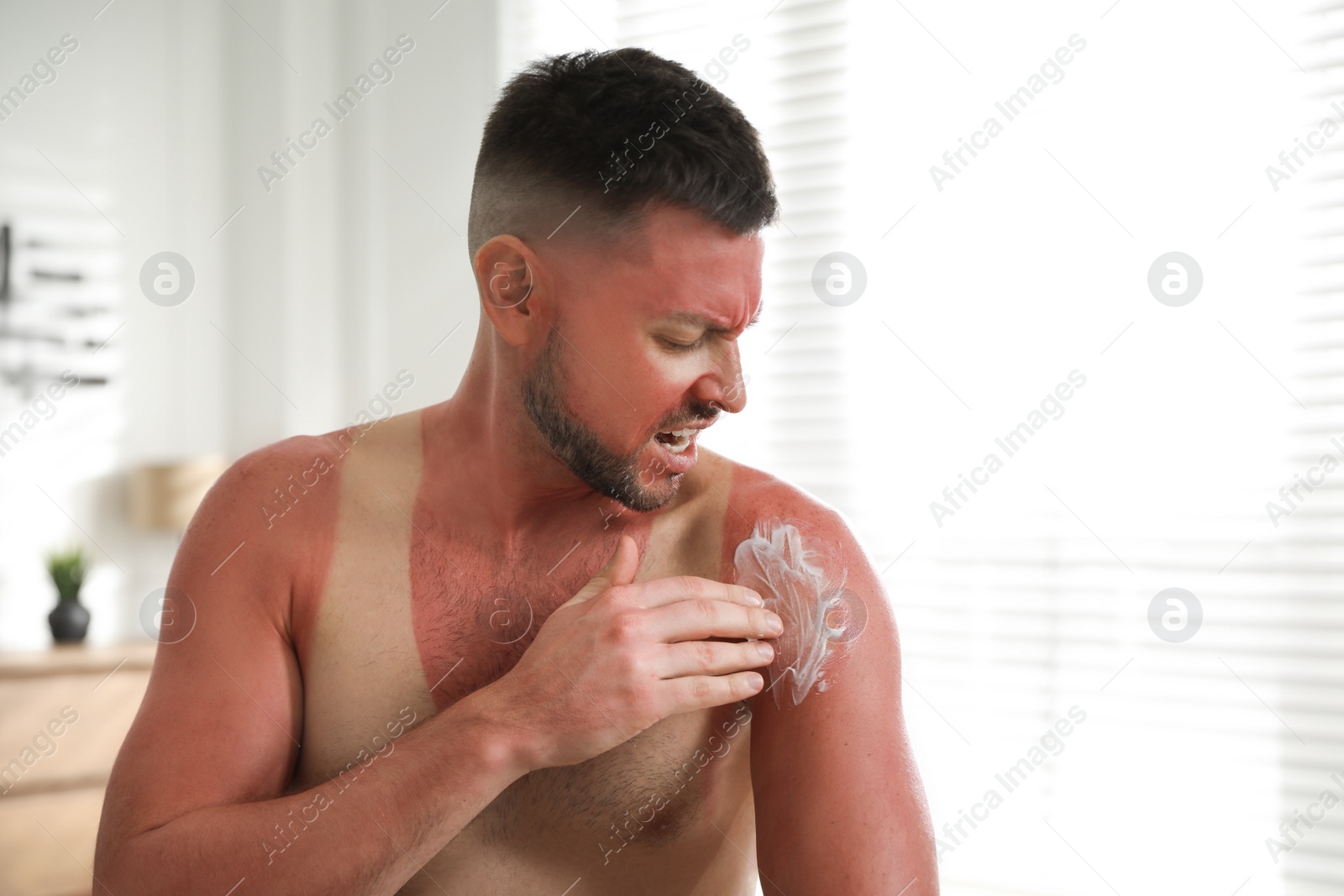 Photo of Man applying cream on sunburn at home