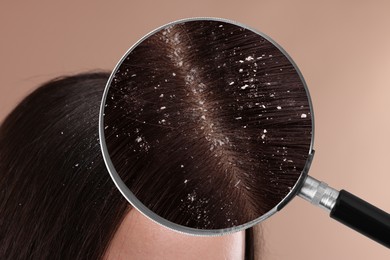 Woman suffering from dandruff on pale brown background, closeup. View through magnifying glass on hair with flakes