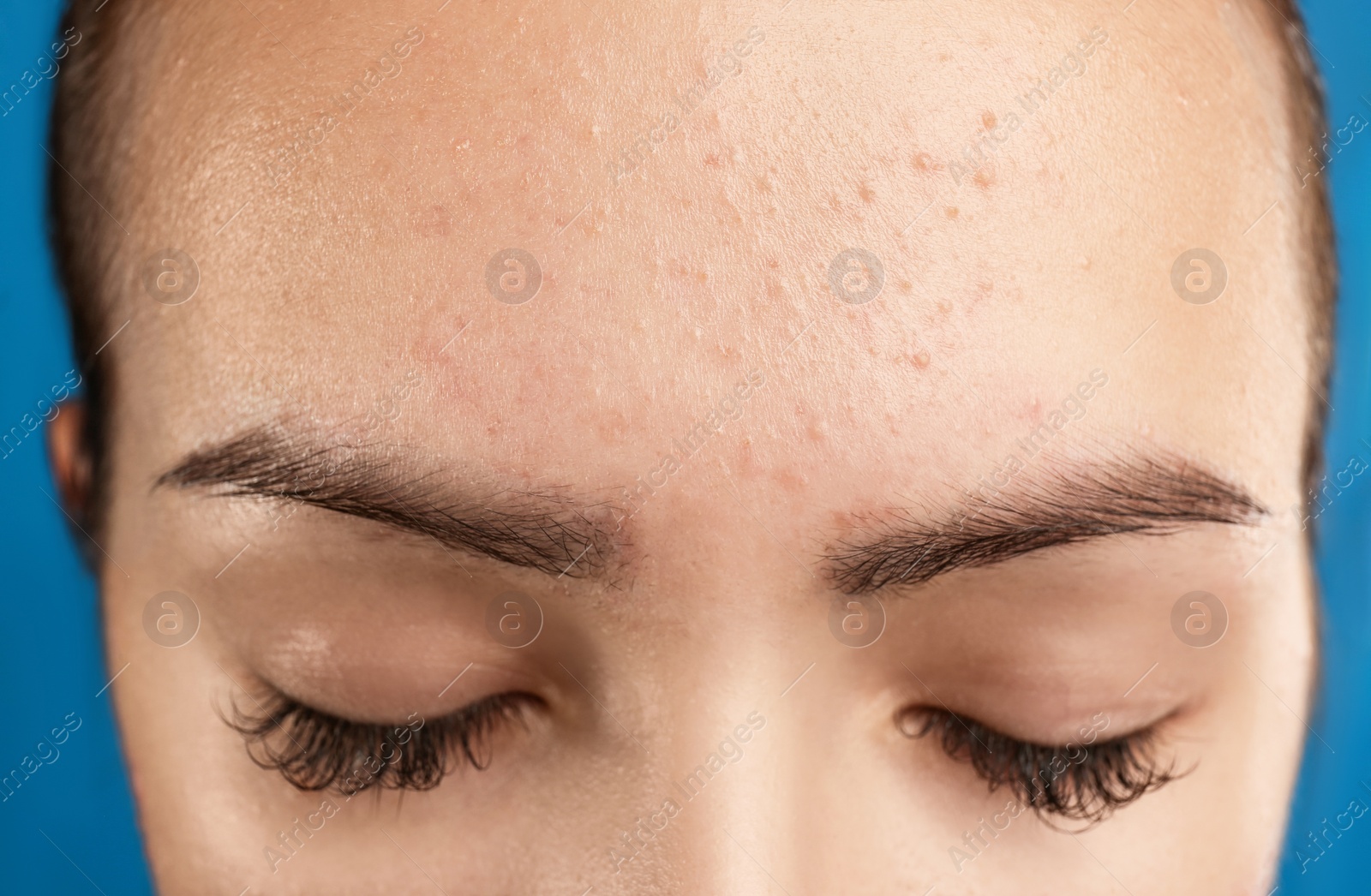 Photo of Teenage girl with acne problem on blue background, closeup