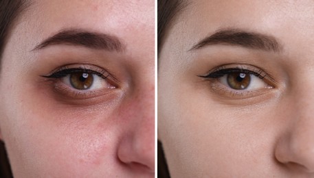 Image of Collage with photos of woman with dark circle under eye before and after treatment, closeup