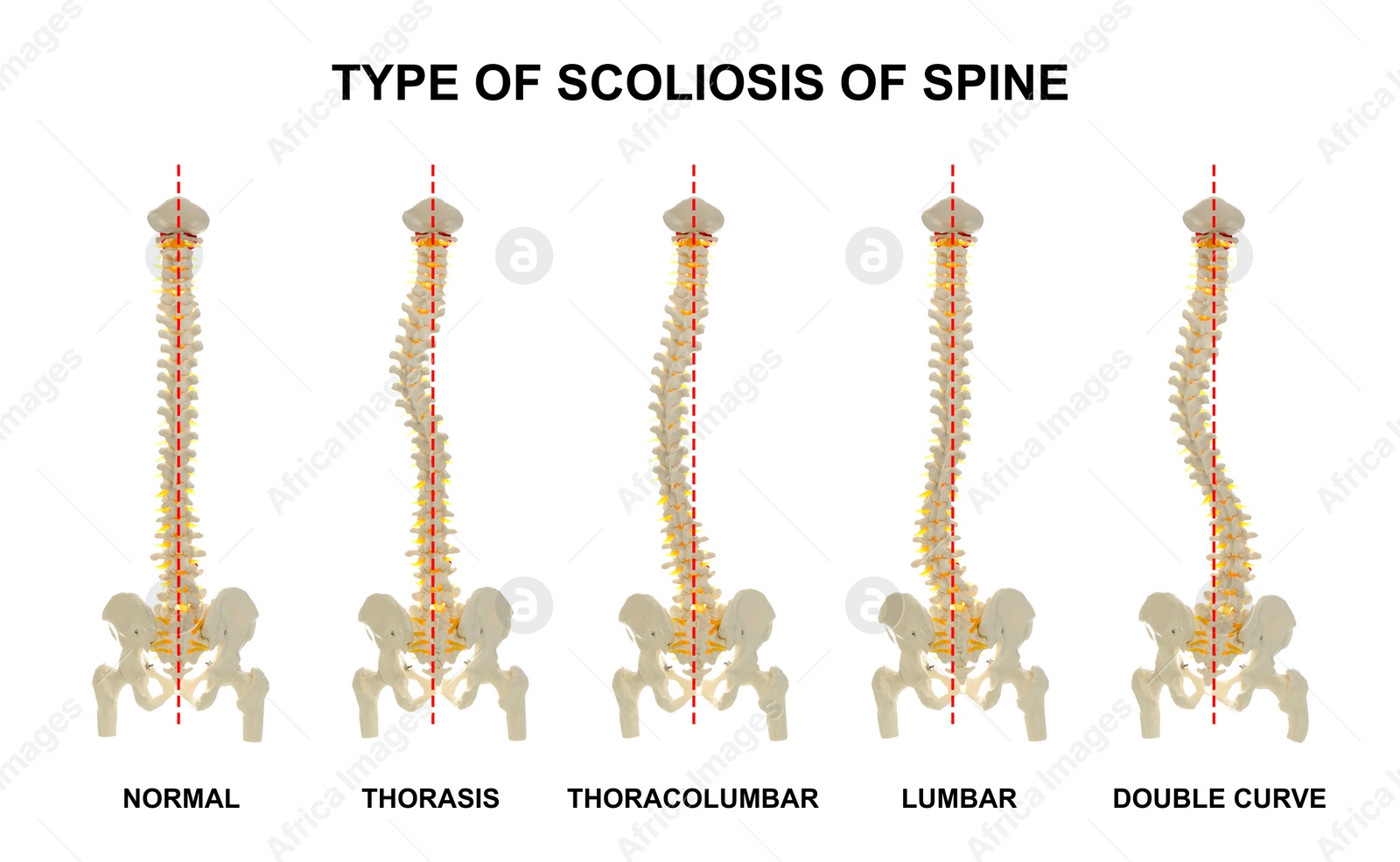 Illustration of Medical poster demonstrating types of scoliosis on white background.  healthy and diseased spine