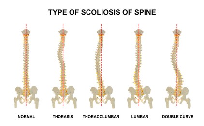 Medical poster demonstrating types of scoliosis on white background. Illustration of healthy and diseased spine