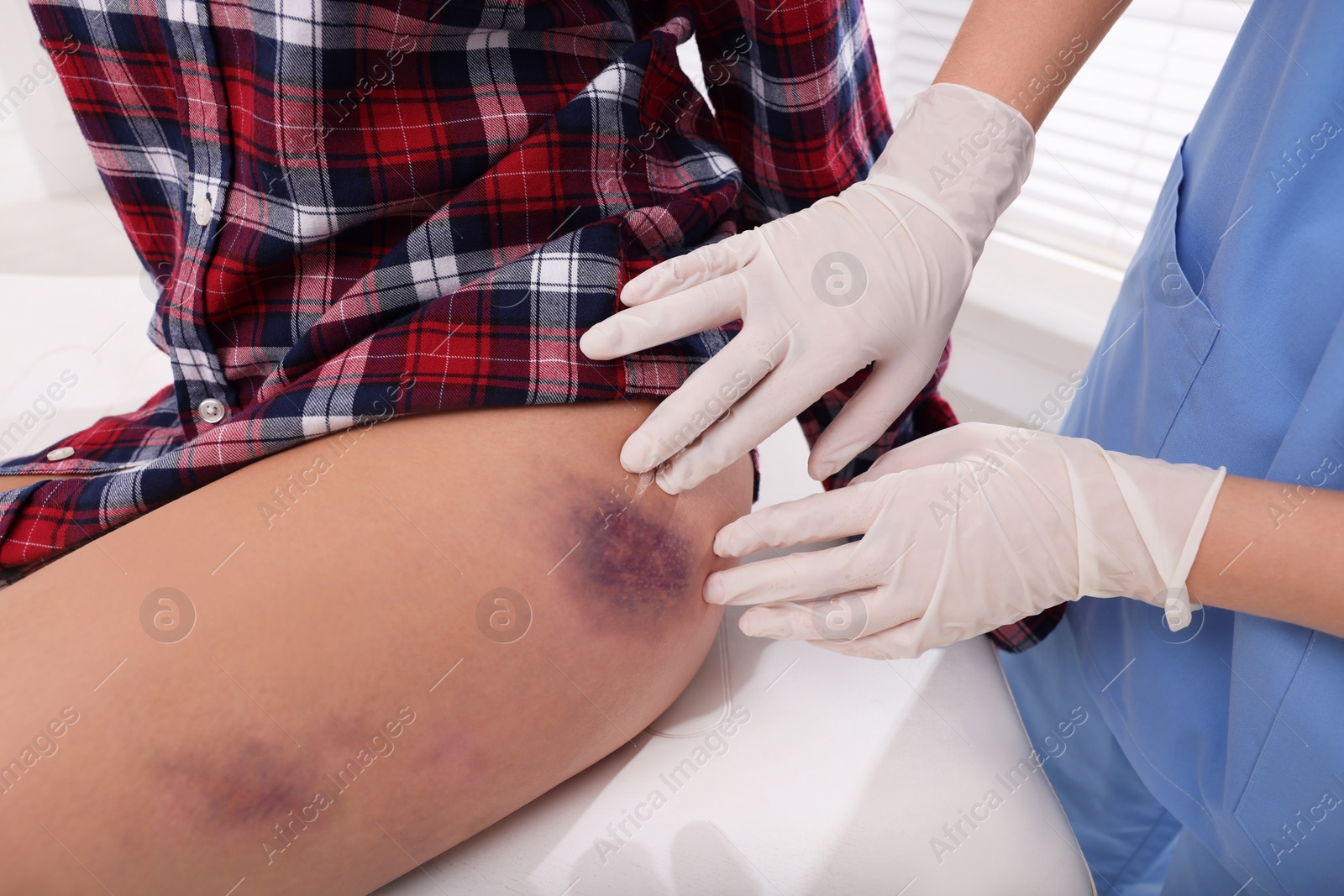 Photo of Doctor examining patient's bruised hip in hospital, closeup