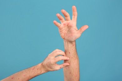 Photo of Man with rash suffering from monkeypox virus on light blue background, closeup. Space for text