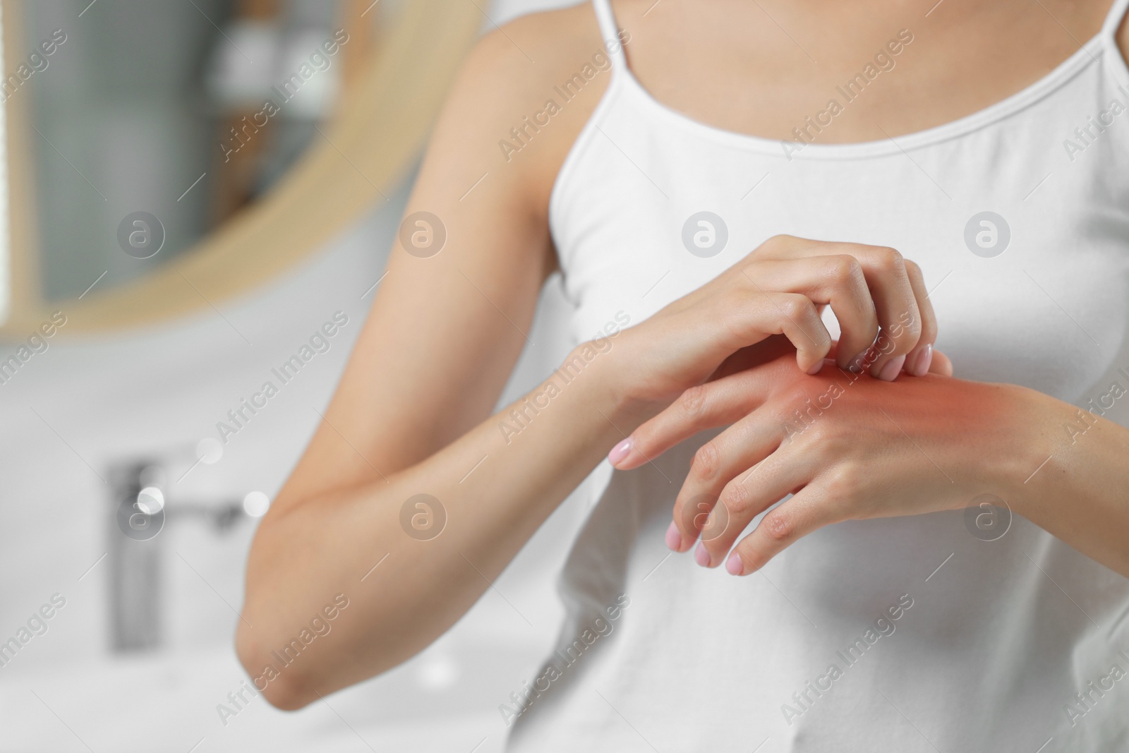 Photo of Suffering from allergy. Young woman scratching her hand indoors, closeup