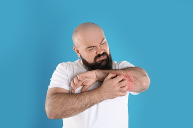 Photo of Man with allergy symptoms scratching forearm on color background