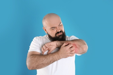 Man with allergy symptoms scratching forearm on color background