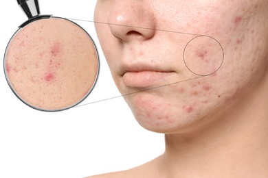 Dermatology. Woman with skin problem on white background, closeup. View through magnifying glass on acne