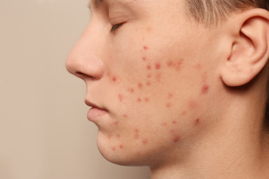 Photo of Teen guy with acne problem on beige background, closeup