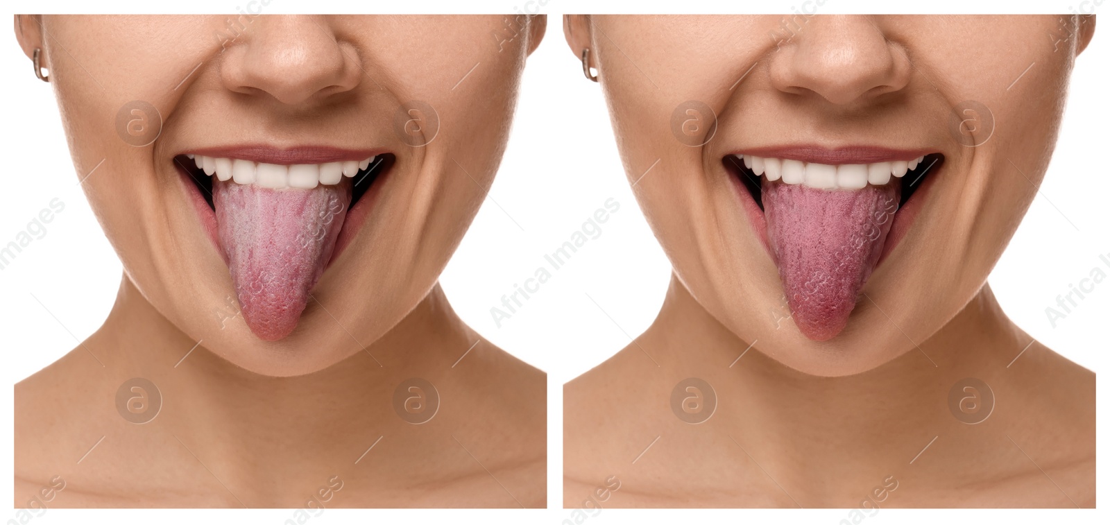 Image of Collage with photos of woman before and after tongue cleaning on white background, closeup