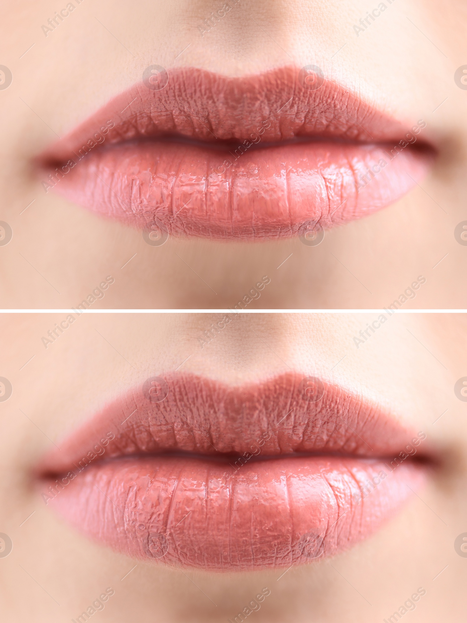 Image of Woman before and after lip correction procedure, closeup