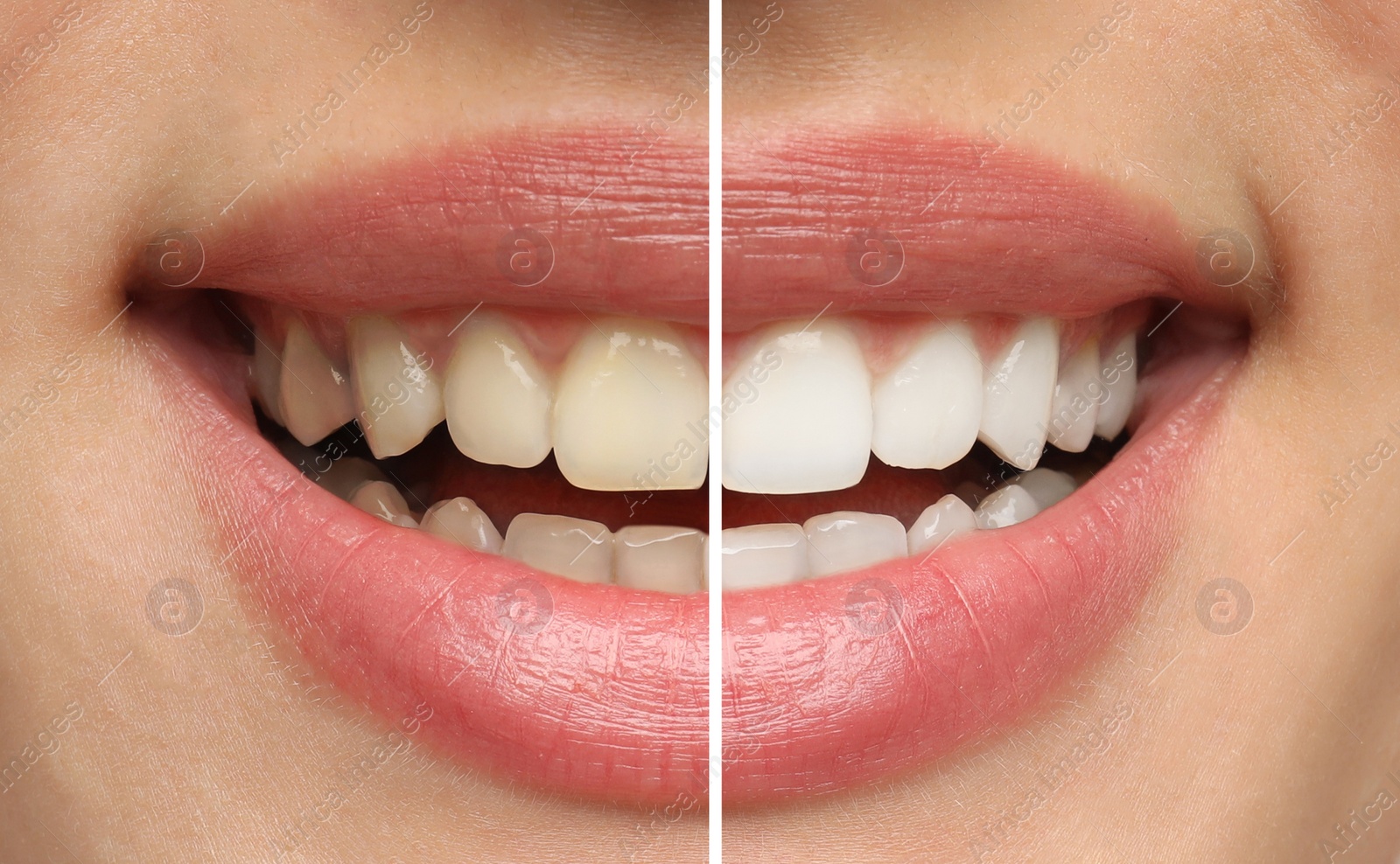 Image of Collage with photos of woman before and after teeth whitening, closeup