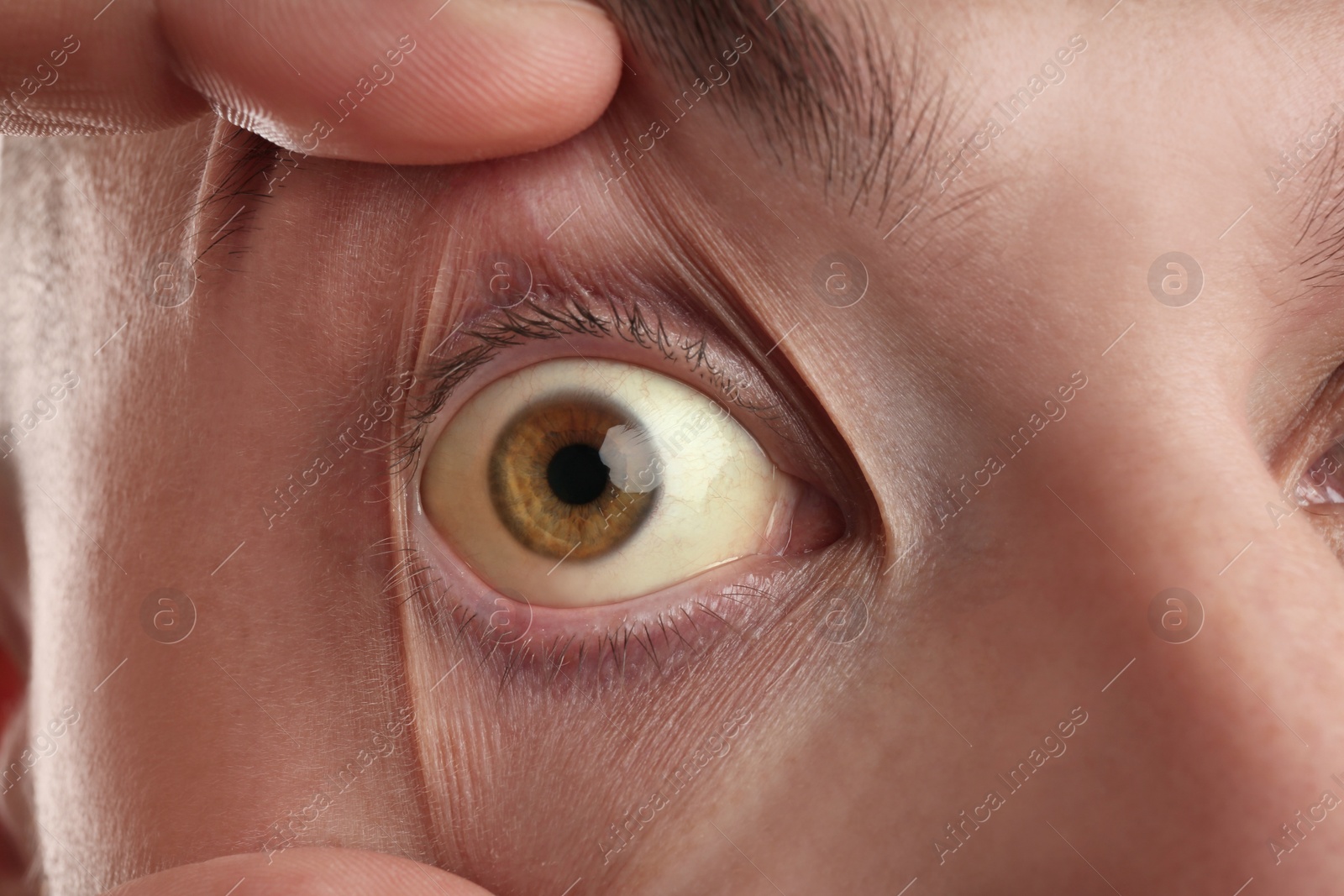 Photo of Man checking his health condition, closeup. Yellow eyes as symptom of problems with liver