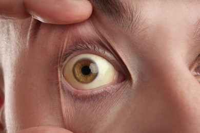 Photo of Man checking his health condition, closeup. Yellow eyes as symptom of problems with liver