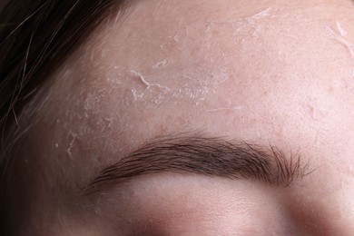 Woman with dry skin on forehead, macro view