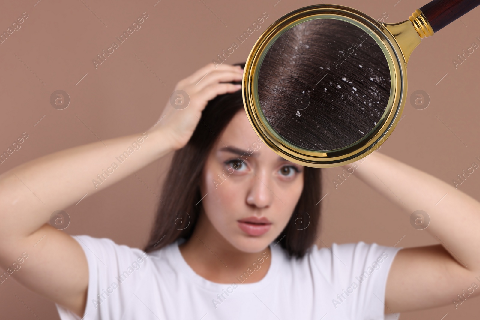 Image of Woman suffering from dandruff on pale brown background. View through magnifying glass on hair with flakes
