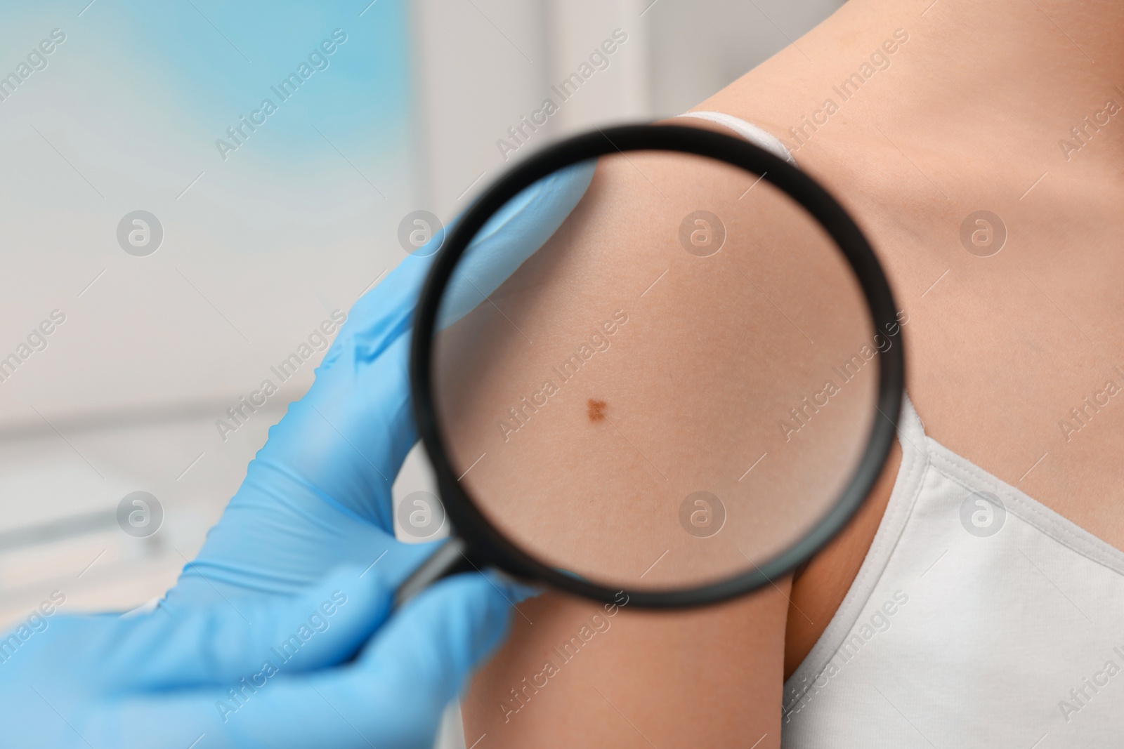 Photo of Dermatologist examining patient's birthmark with magnifying glass indoors, closeup