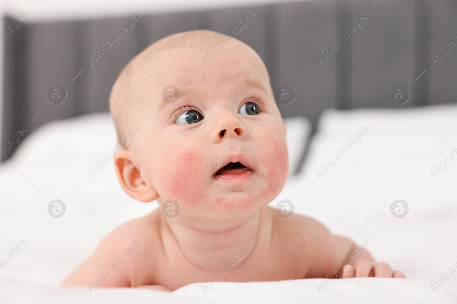 Photo of Cute little baby with allergic redness on cheeks lying on bed at home