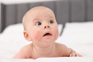 Photo of Cute little baby with allergic redness on cheeks lying on bed at home