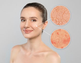 Image of Young woman with facial dry skin problem on light grey background