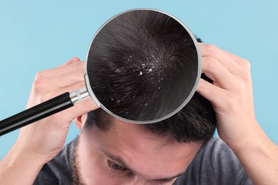 Man suffering from dandruff on light blue background, closeup. View through magnifying glass on hair with flakes