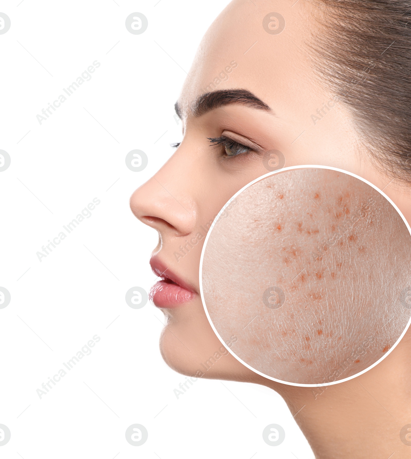 Image of Woman with acne on her face on white background. Zoomed area showing problem skin