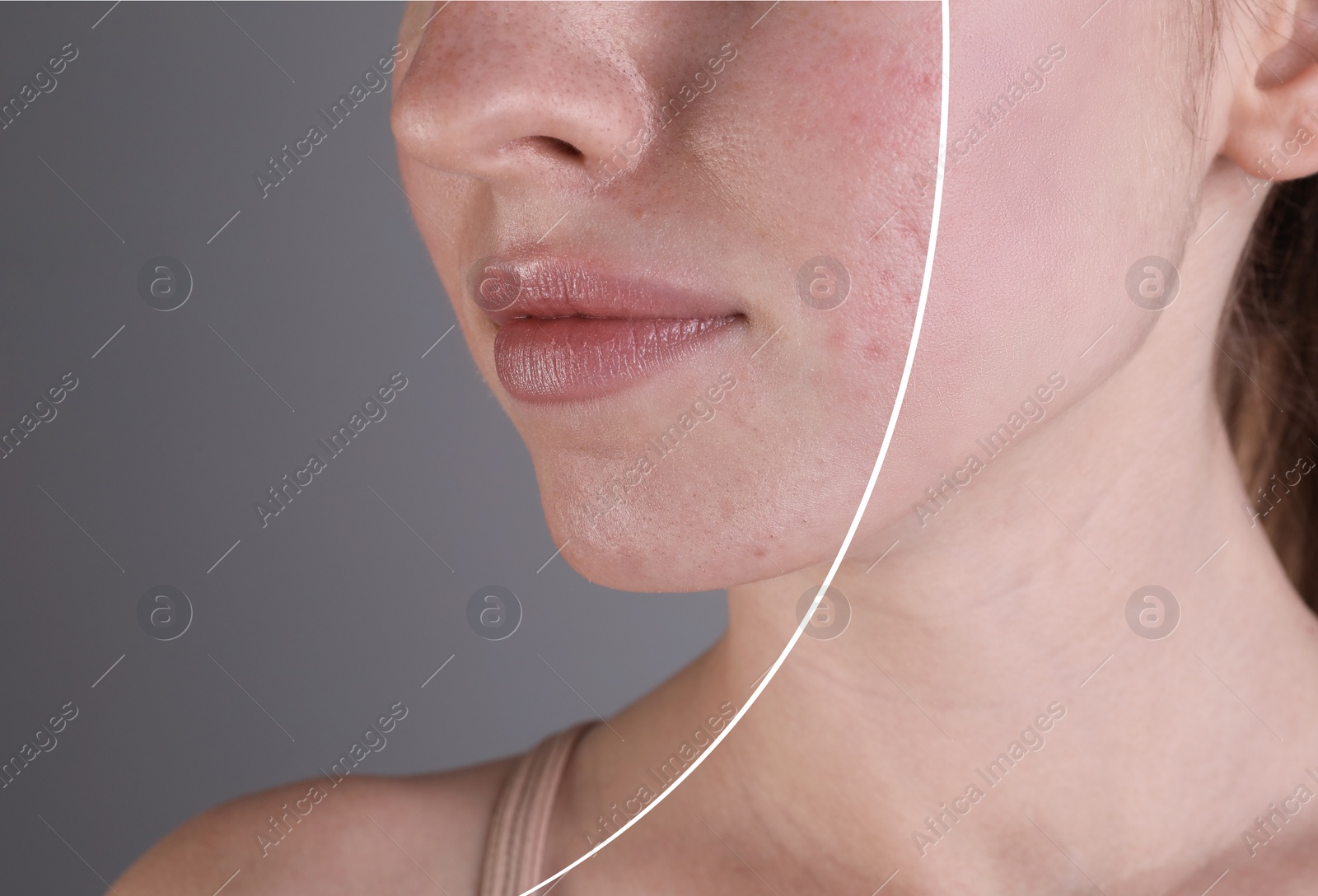 Image of Acne problem, collage. Woman before and after treatment on grey background, closeup