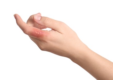 Photo of Woman with burn of her hand on white background, closeup