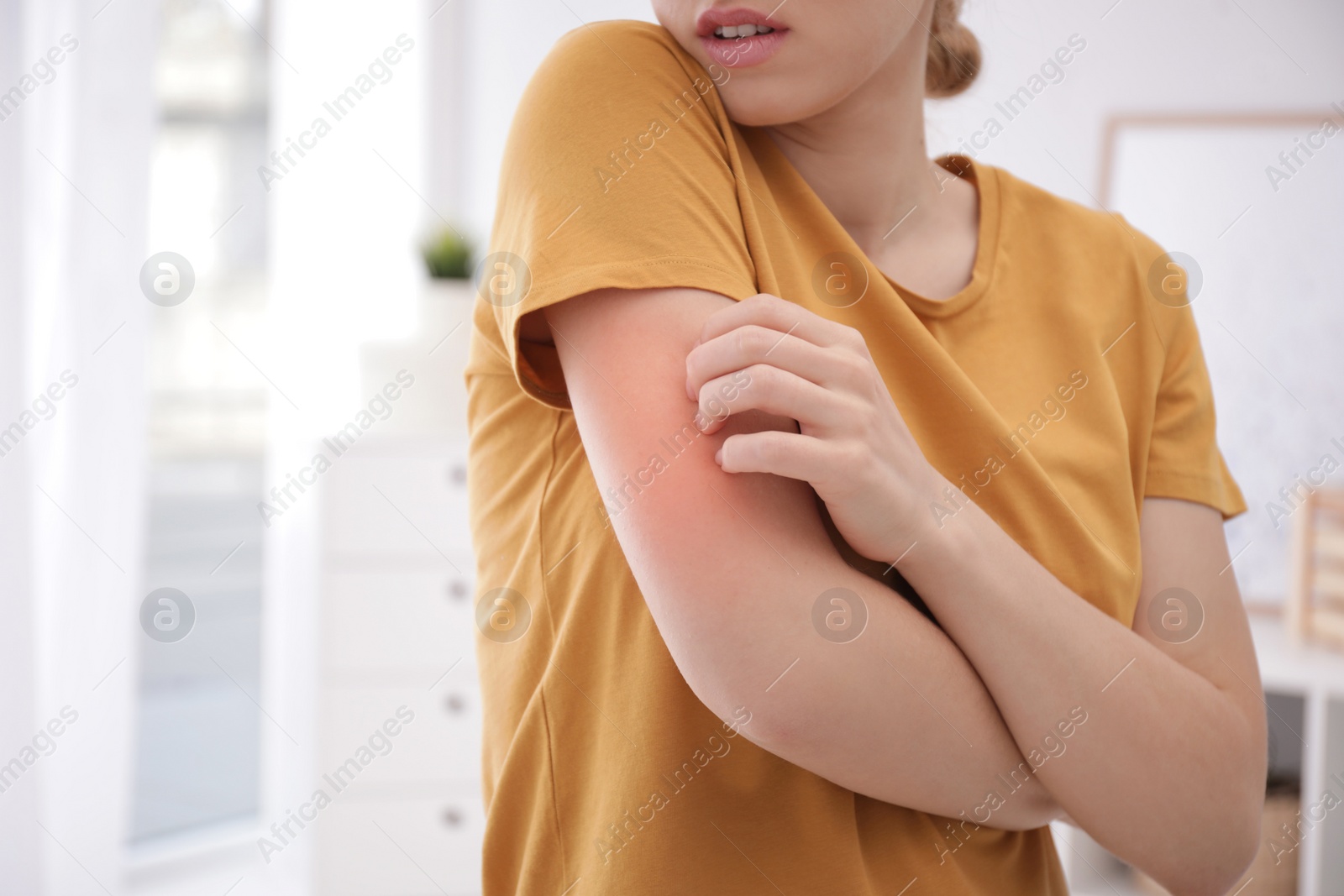 Photo of Woman scratching arm indoors, closeup with space for text. Allergy symptoms