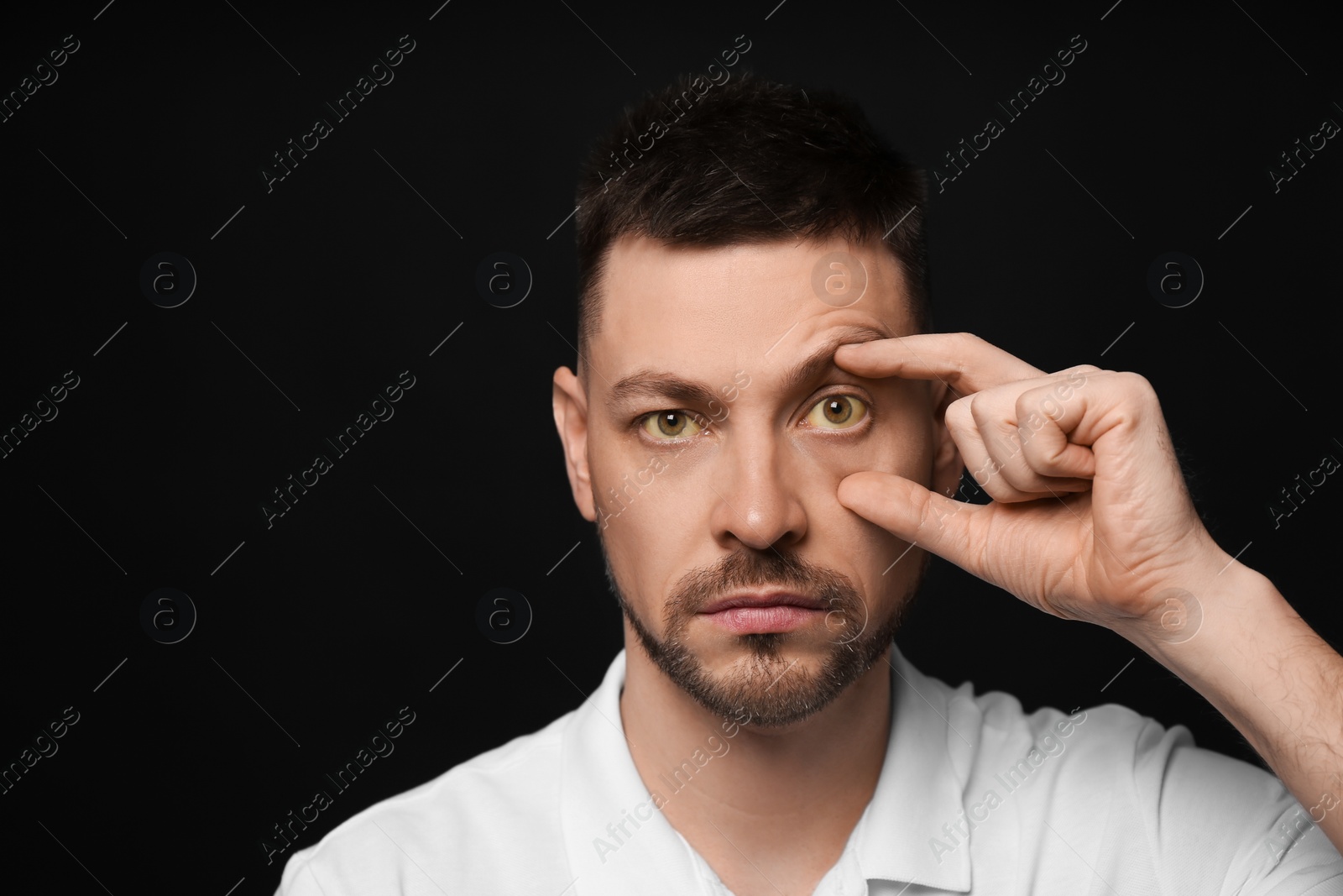 Photo of Man checking his health condition on black background, space for text. Yellow eyes as symptom of problems with liver
