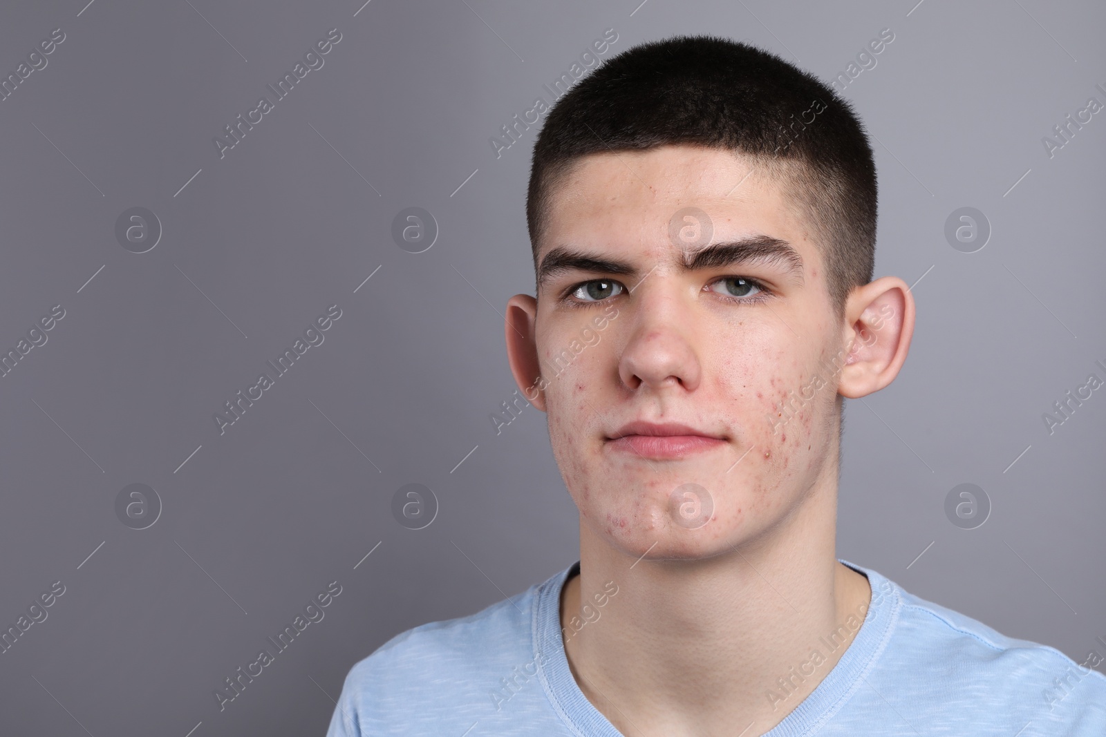 Photo of Young man with acne problem on grey background. Space for text