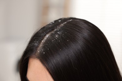 Woman with dandruff in her dark hair on blurred background, closeup