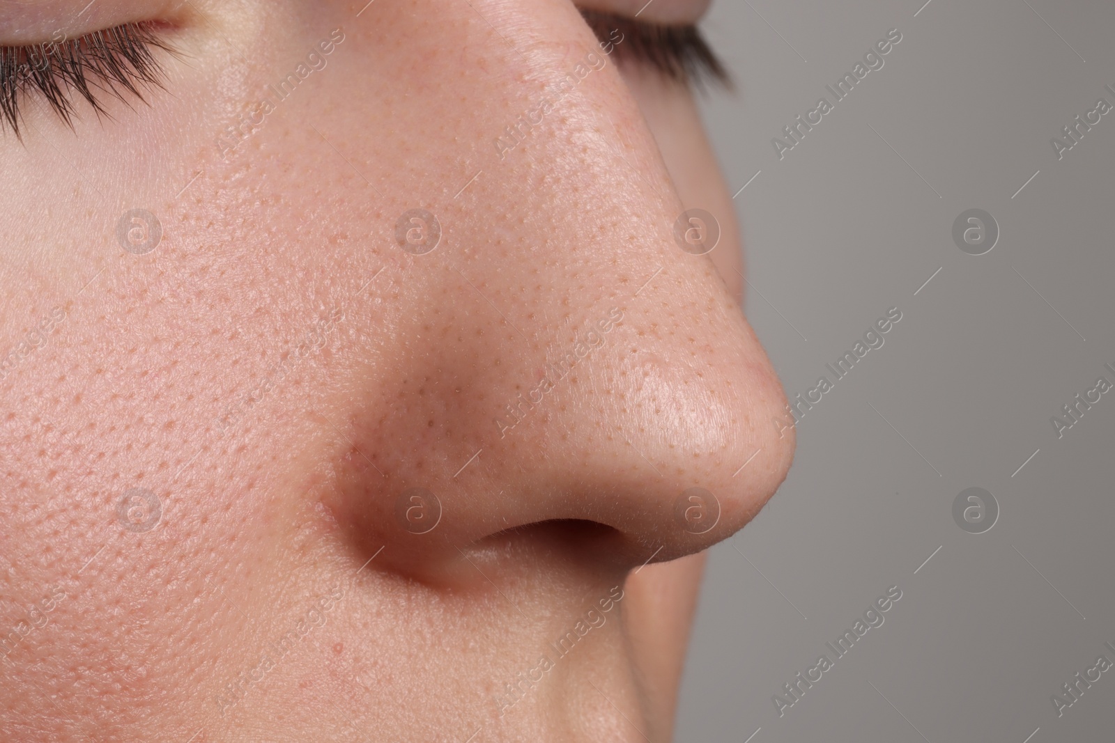 Photo of Young woman with acne problem on grey background, closeup view of nose. Space for text