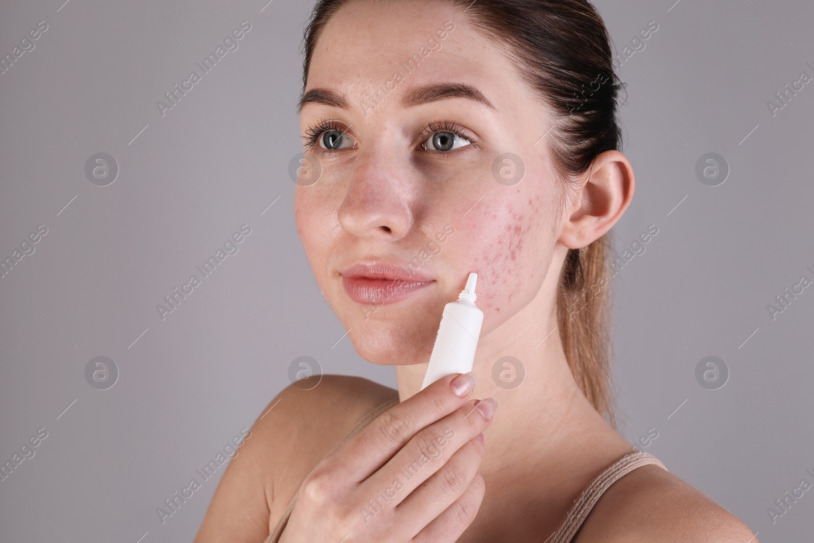 Photo of Young woman with acne problem applying cosmetic product onto her skin on light grey background