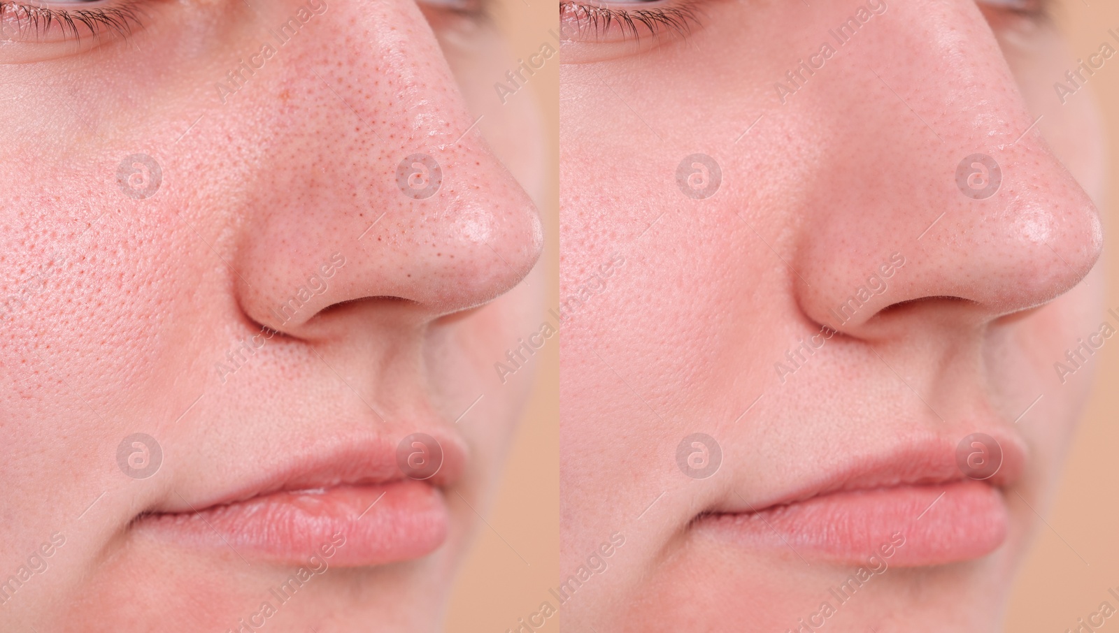 Image of Blackhead treatment, before and after. Collage with photos of woman, closeup view