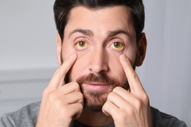 Photo of Man with yellow eyes on blurred background, closeup. Symptom of hepatitis