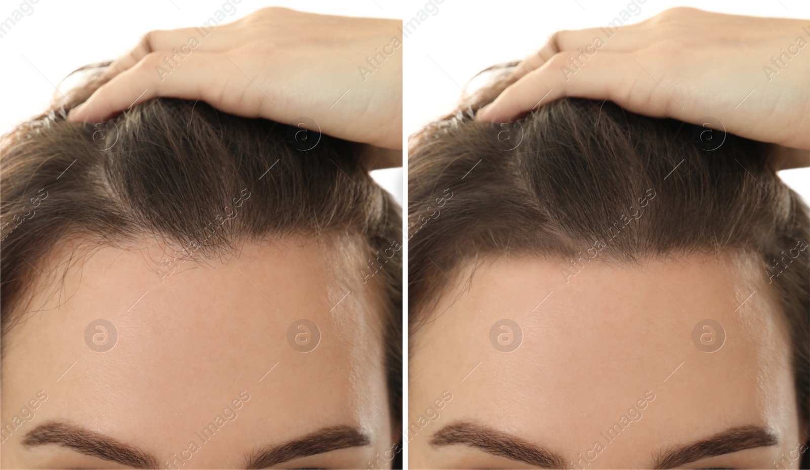 Image of Woman suffering from baldness on white background, closeup. Collage with photos before and after treatment