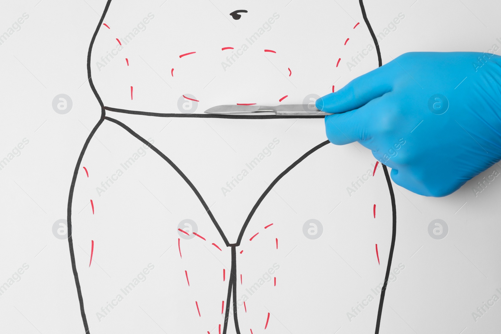 Photo of Doctor holding scalpel near drawn human body with marks on white background, top view. Weight loss surgery