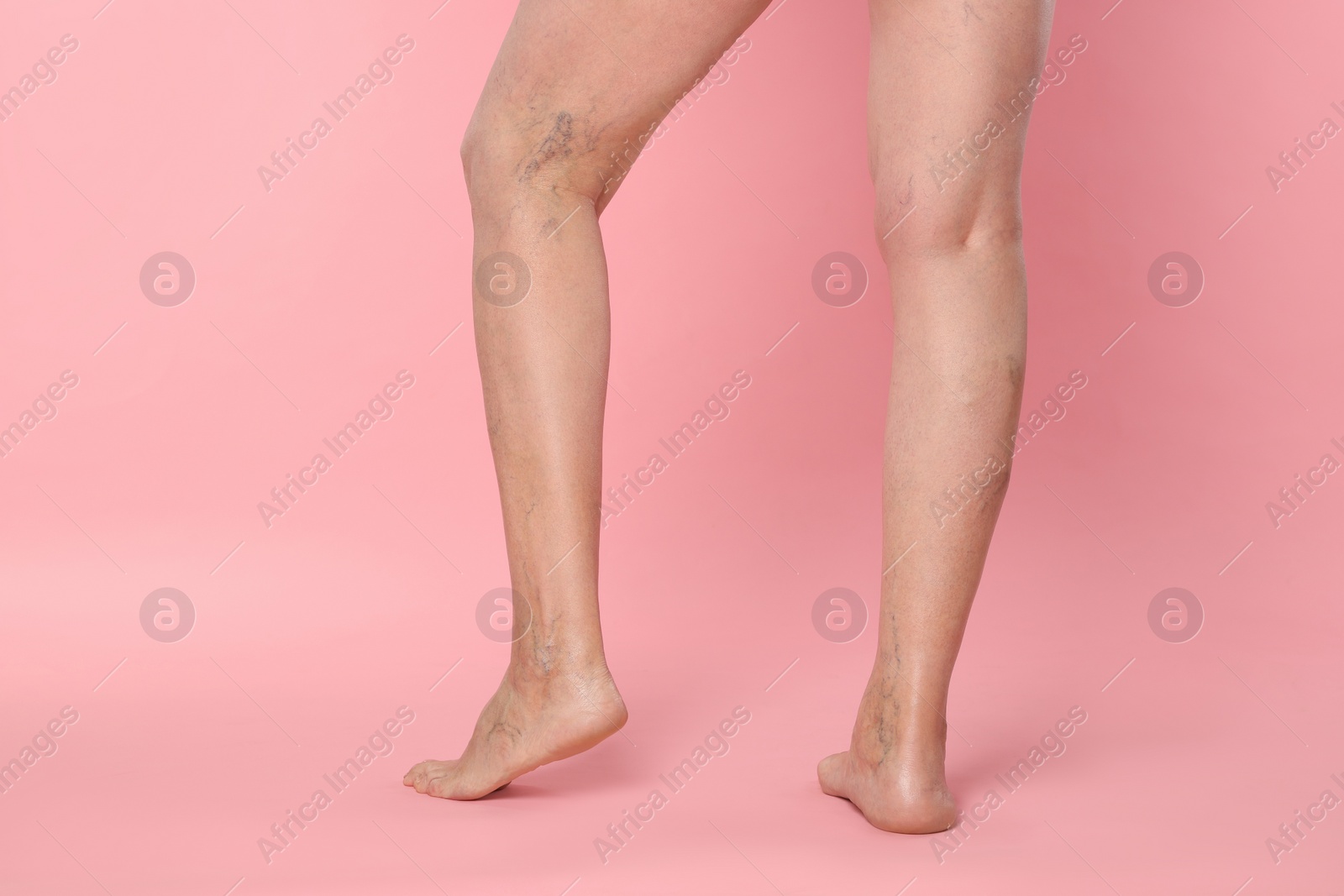 Photo of Closeup view of woman with varicose veins on pink background