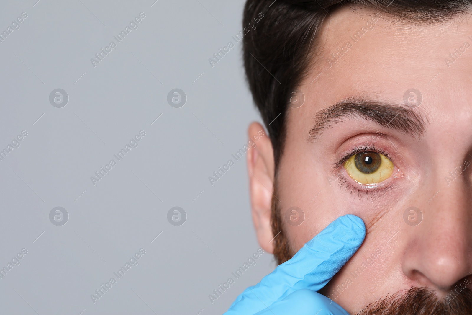 Photo of Doctor checking man with yellow eyes on grey background, closeup. Symptom of hepatitis