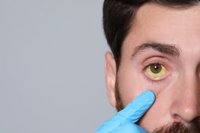 Photo of Doctor checking man with yellow eyes on grey background, closeup. Symptom of hepatitis