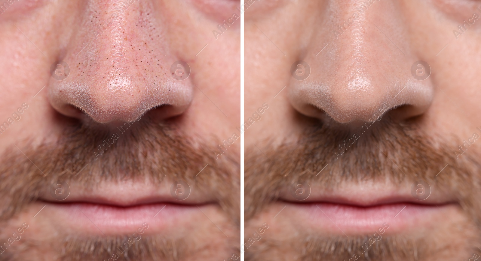 Image of Blackhead treatment, before and after. Collage with photos of man, closeup view